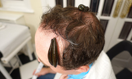 Leech Therapy - Hair Loss Treatment